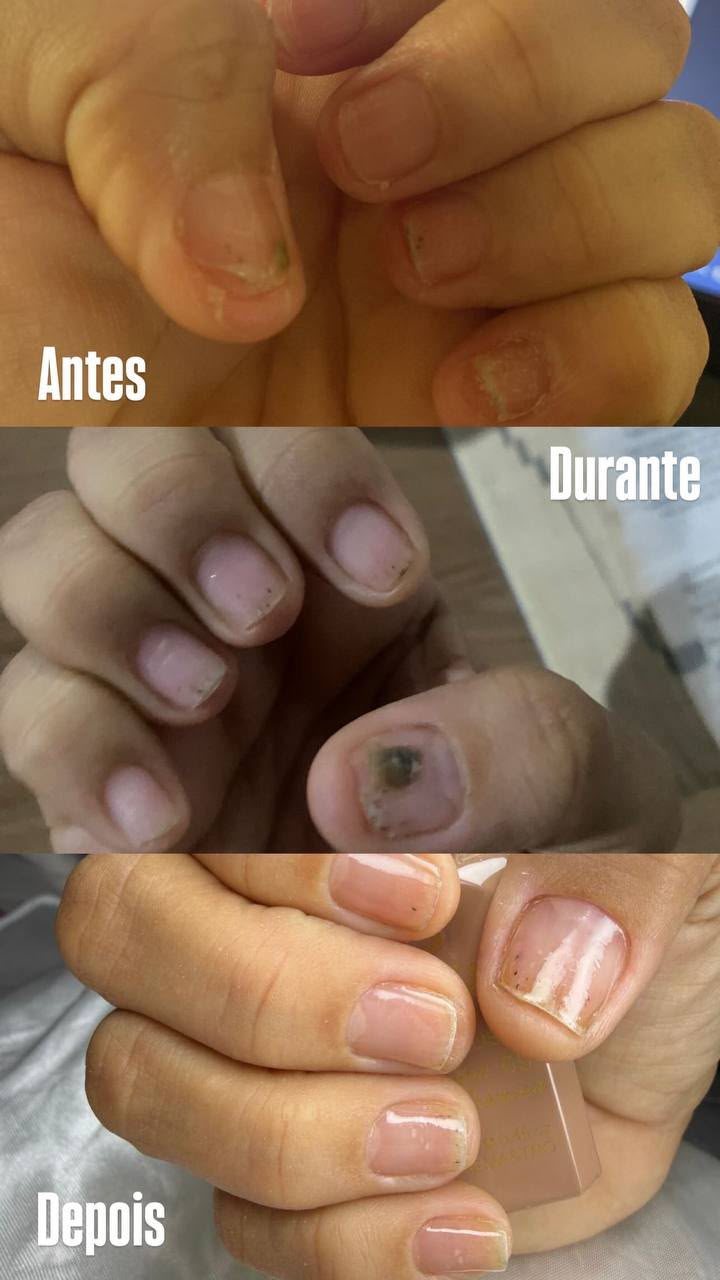 Unhas antes, durante e depois